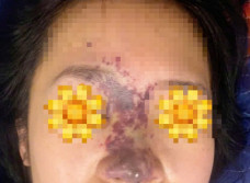 Tiêm filler trôi nổi, có người phải trải qua hơn 60 ca phẫu thuật để xử lý hậu quả