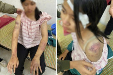 Bé gái 13 tuổi bị ông bà bạo hành đến mức nhập viện cấp cứu