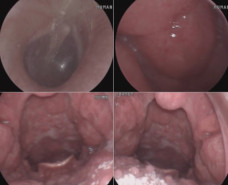 Thanh niên 22 tuổi ở Hà Nội đau họng kéo dài, đi khám mới thừa nhận một sai lầm trong chuyện 'thầm kín'