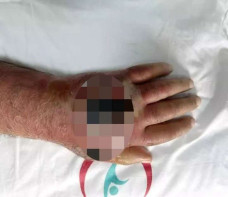 Bị kẻ trộm cắn, người đàn ông suýt phải cắt bỏ tay