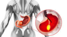 Ung thư tuyến tụy là sát thủ thầm lặng, làm thế nào để tránh?